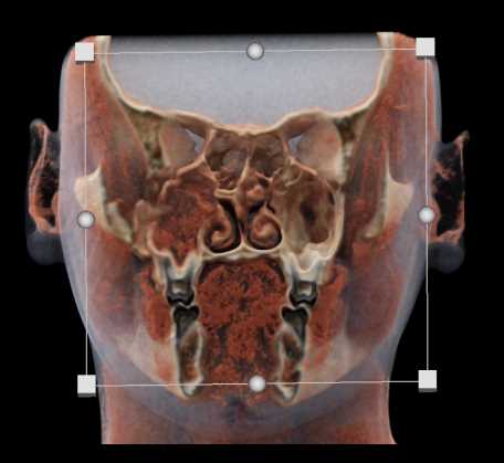Right Orbital Fracture - CTisus CT Scan