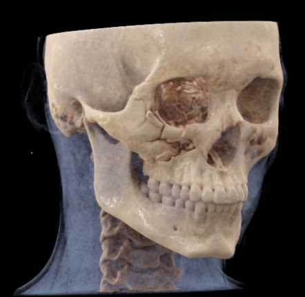 Orbital Fractures - CTisus CT Scan