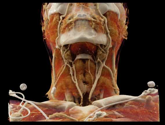 CR of the Neck with Vascular Mapping - CTisus CT Scan