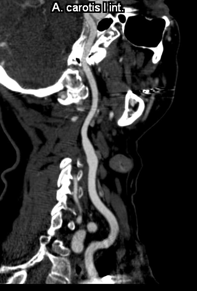 Carotid Artery Plaque - CTisus CT Scan