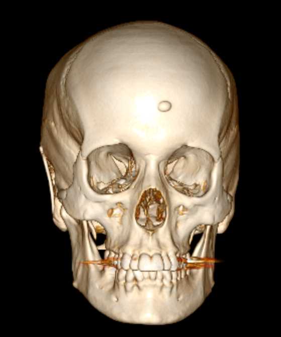 Prior Repair of Tumor Resection Sites - CTisus CT Scan