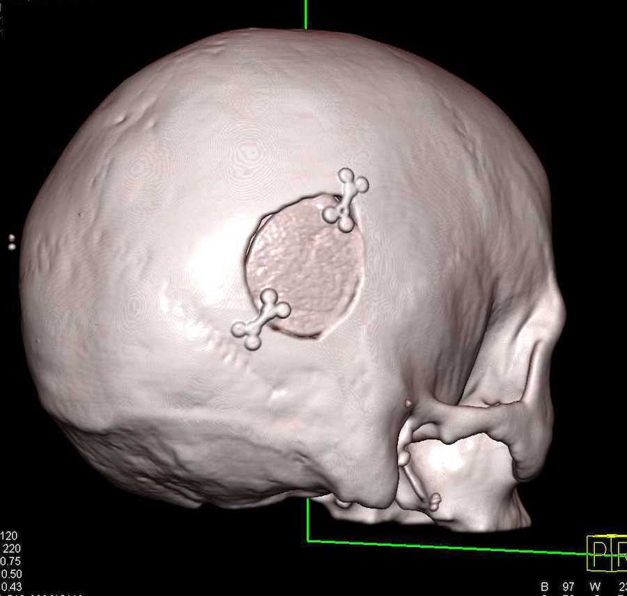 Patient post Craniectomy - CTisus CT Scan