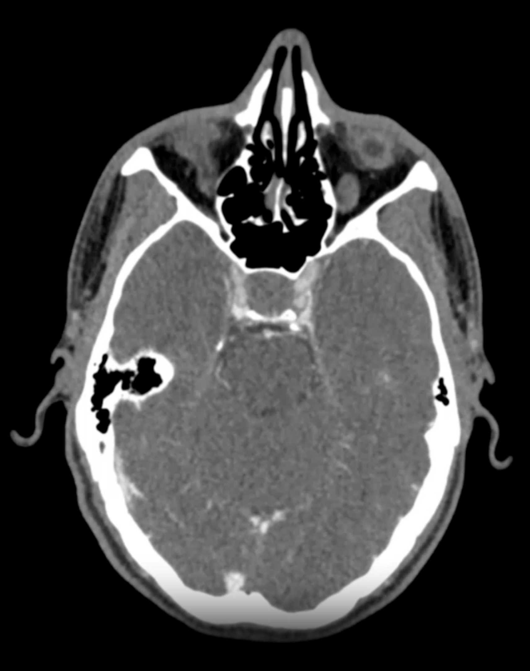 Pituitary Adenoma Secretes GH - CTisus CT Scan