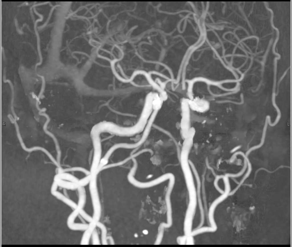 Carotid Artery Disease - CTisus CT Scan