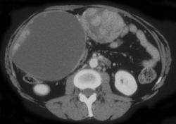 Implants From Ovarian Cancer - CTisus CT Scan