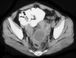 Vaginal Cuff Abscess - CTisus CT Scan