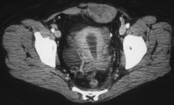 Fluid in Uterine Cavity Due to Cervical Cancer - CTisus CT Scan