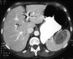 Implants on Spleen- Secondary Cancer Ovary - CTisus CT Scan