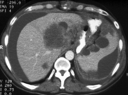 Extensive Implants Secondary Cancer Ovary - CTisus CT Scan