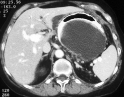 Ascites in Lesser Sac - CTisus CT Scan