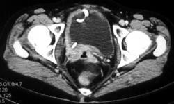 Cervical Cancer Extends to the Pelvic Sidewall - CTisus CT Scan