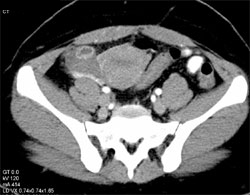 Corpus Luteum Cyst - CTisus CT Scan