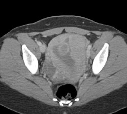 Early Pregnancy - CTisus CT Scan