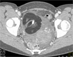 Dermoid - CTisus CT Scan