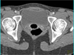 Tampon in Vagina - CTisus CT Scan