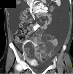 Ovarian Cystadenocarcinoma With Ascites - CTisus CT Scan