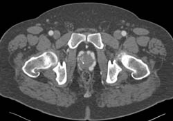 Pelvic Varices- Incidental Findings - CTisus CT Scan
