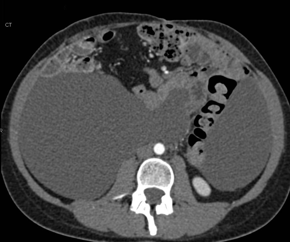Loculated Ascites in Ovarian Cancer - CTisus CT Scan