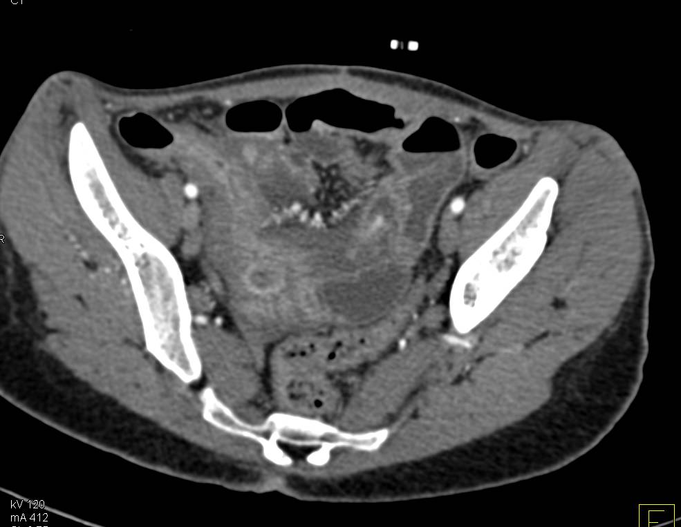 Pelvic Abscess - CTisus CT Scan