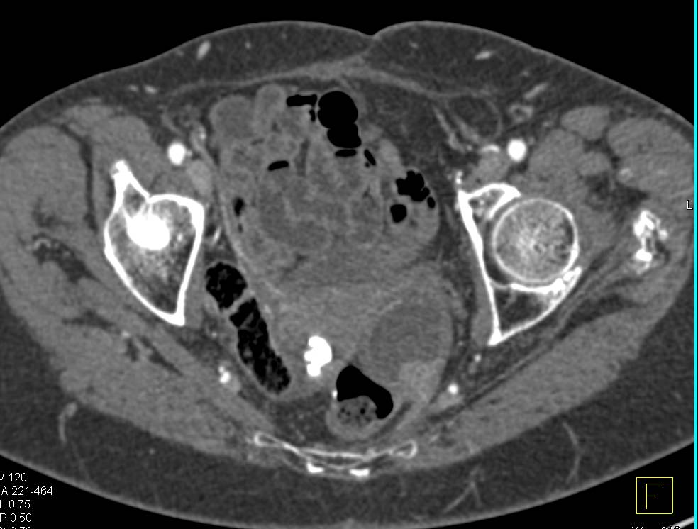 Uterine Fibroids - CTisus CT Scan