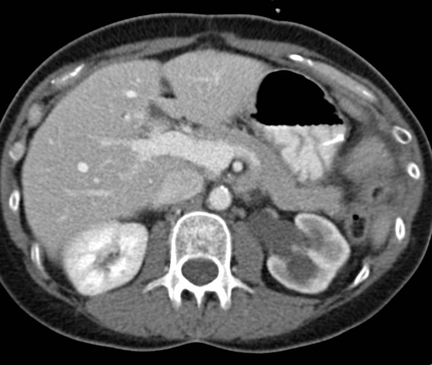 Cervical Cancer Involves the Bladder and the Left Ureter - CTisus CT Scan