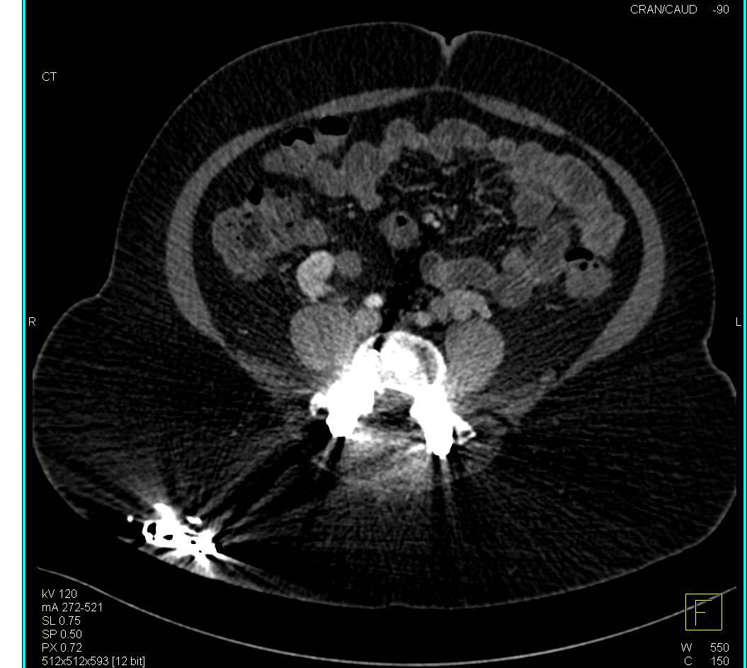 Pelvic Congestion Syndrome - CTisus CT Scan