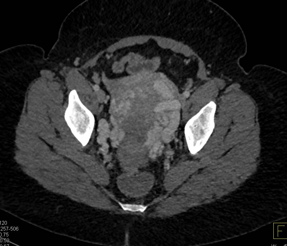 Pelvic Congestion Syndrome - CTisus CT Scan