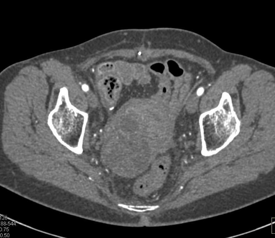 Ovarian Cancer with Uterus Involvement - CTisus CT Scan