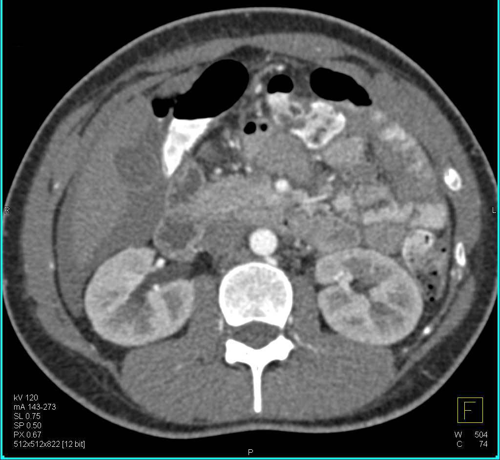 Hemoperitoneum due to Ovarian Cyst Rupture - CTisus CT Scan