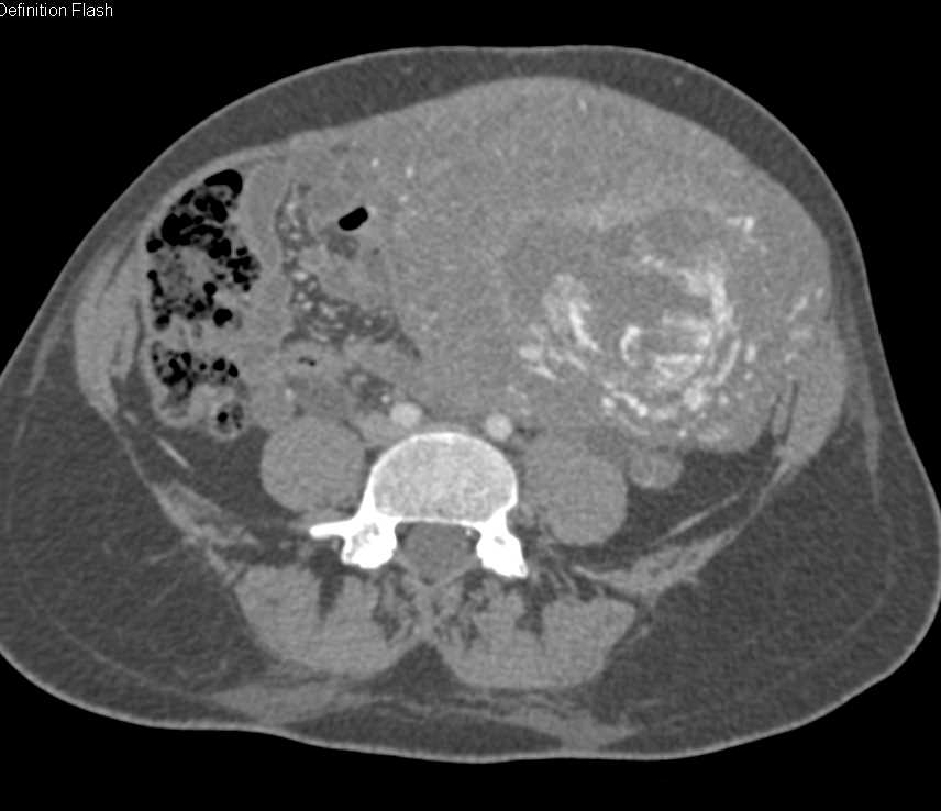 Gestational Trophoblastic Disease with Impressive Vascularity - CTisus CT Scan