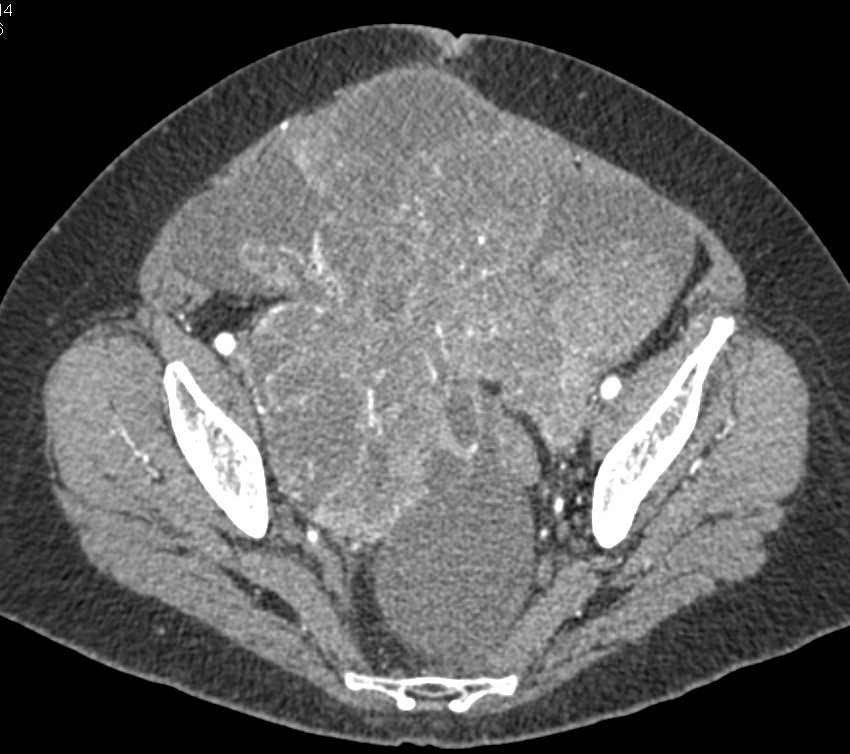 Uterine Sarcoma with Neovascularity - CTisus CT Scan