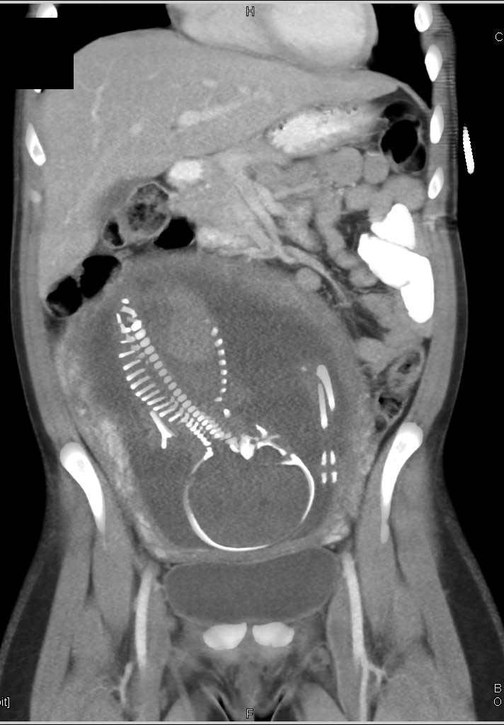 CT of Fetus in a Trauma patient - OB/GYN Case Studies - CTisus CT Scanning