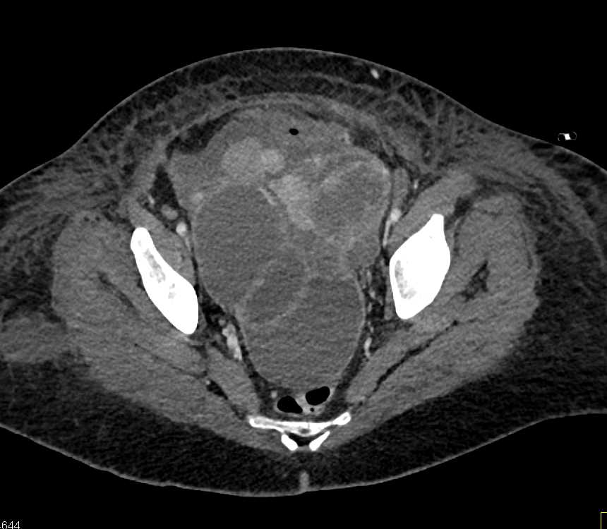 Ovarian Carcinomatosis - CTisus CT Scan