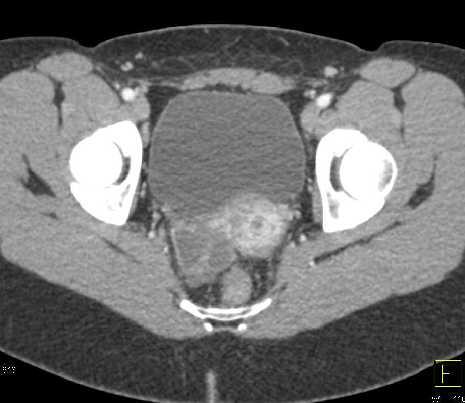 Theca Lutein Cyst on the Left - CTisus CT Scan