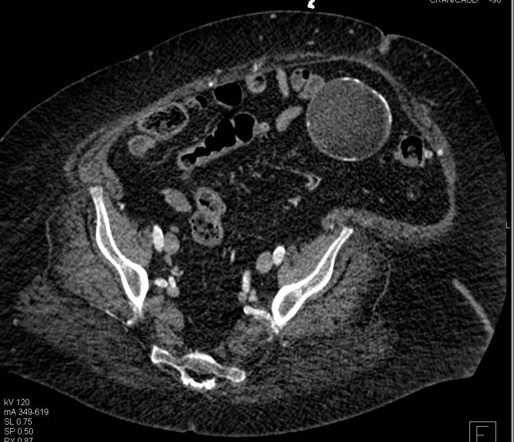 Calcified Cyst in Left Lower Quadrant (LLQ) - CTisus CT Scan