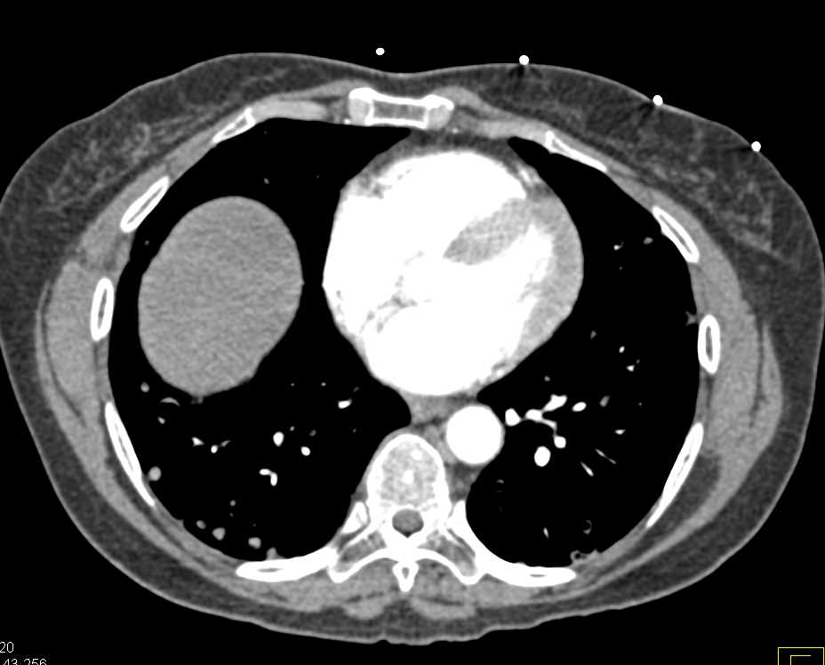Carcinomatosis with Cavitary Lung Metastases due to Ovarian Cancer - CTisus CT Scan