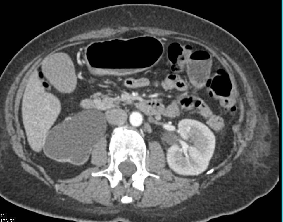 Cervical Carcinoma Infiltrating and Obstructing the Right Ureter - CTisus CT Scan