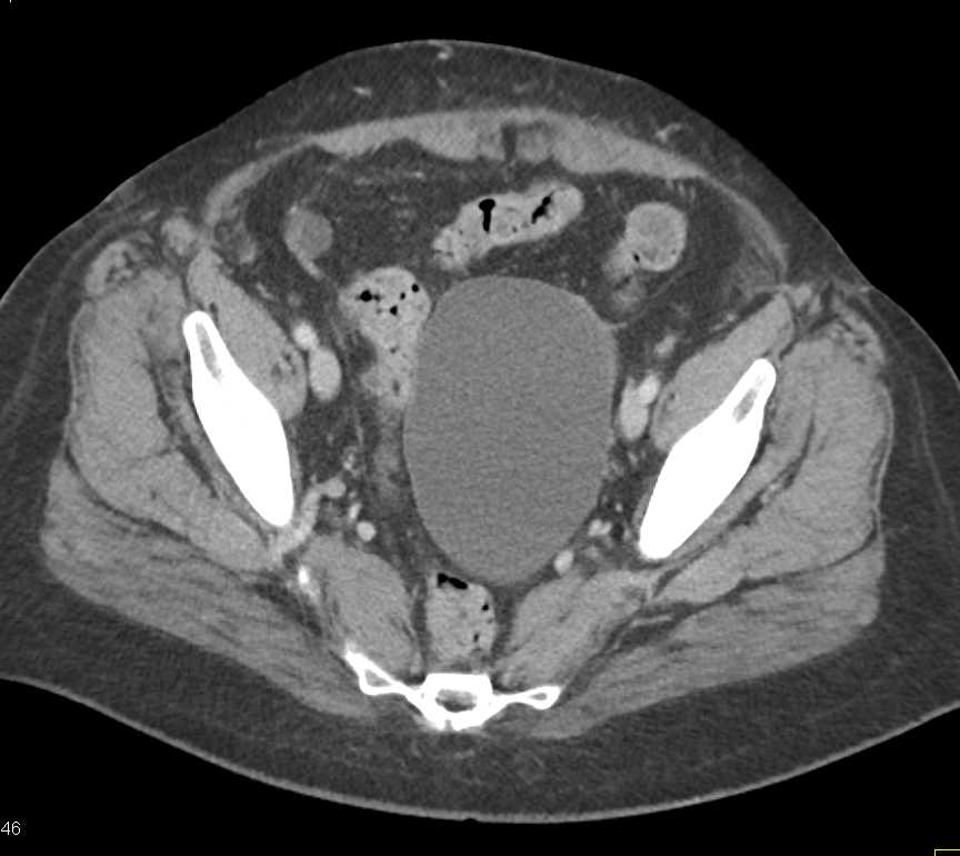 Ovarian Cystadenocarcinoma - CTisus CT Scan