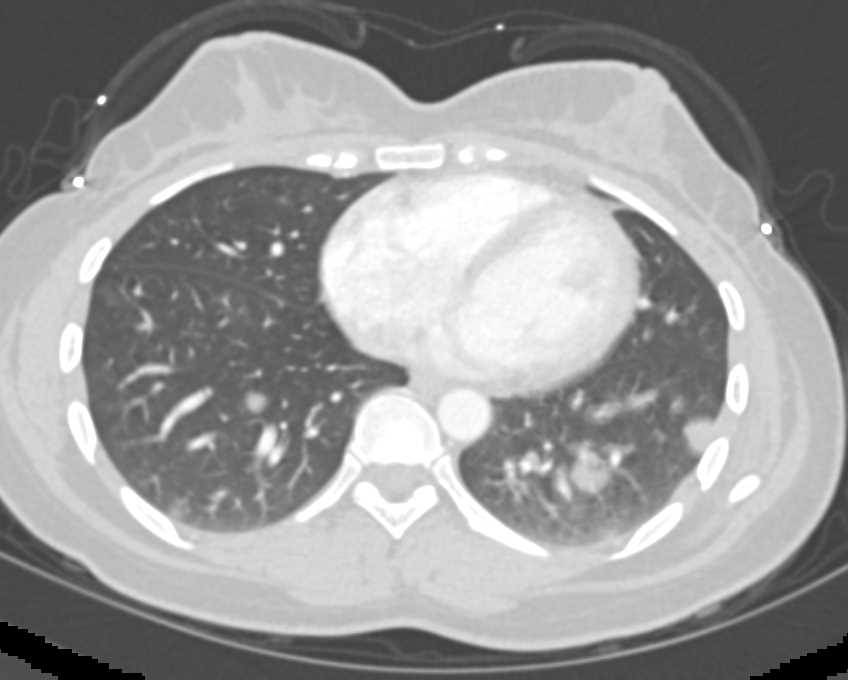 Pelvic Sarcoma with Lung Metastases - CTisus CT Scan