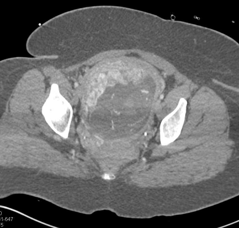 Intrauterine Pregnancy - CTisus CT Scan