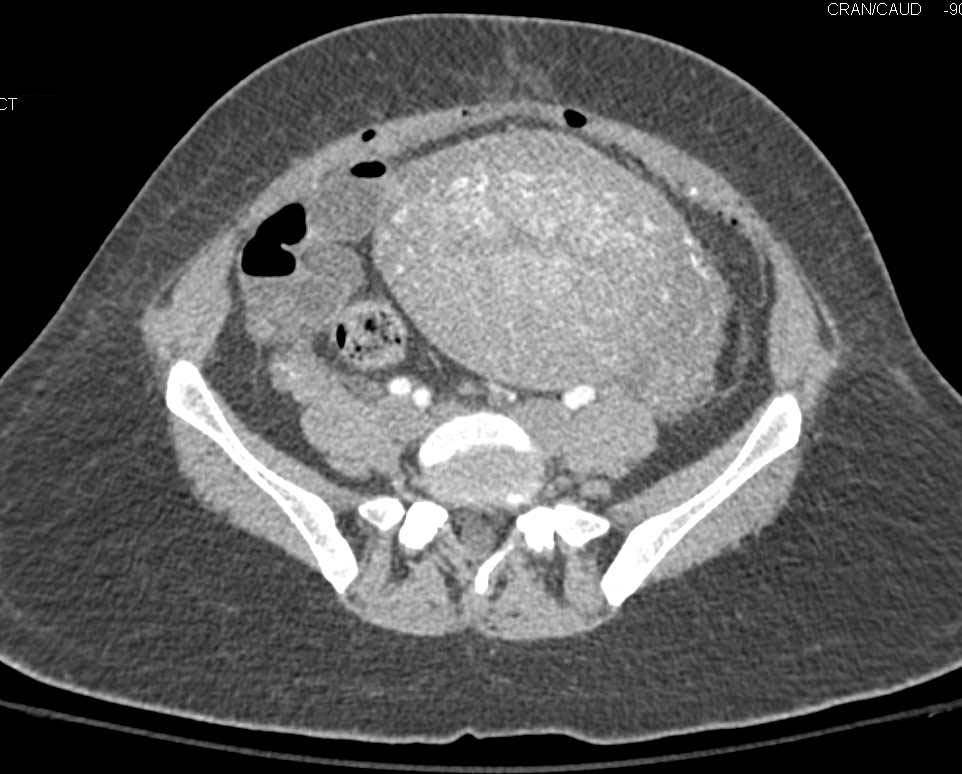 Postpartum Uterus - CTisus CT Scan
