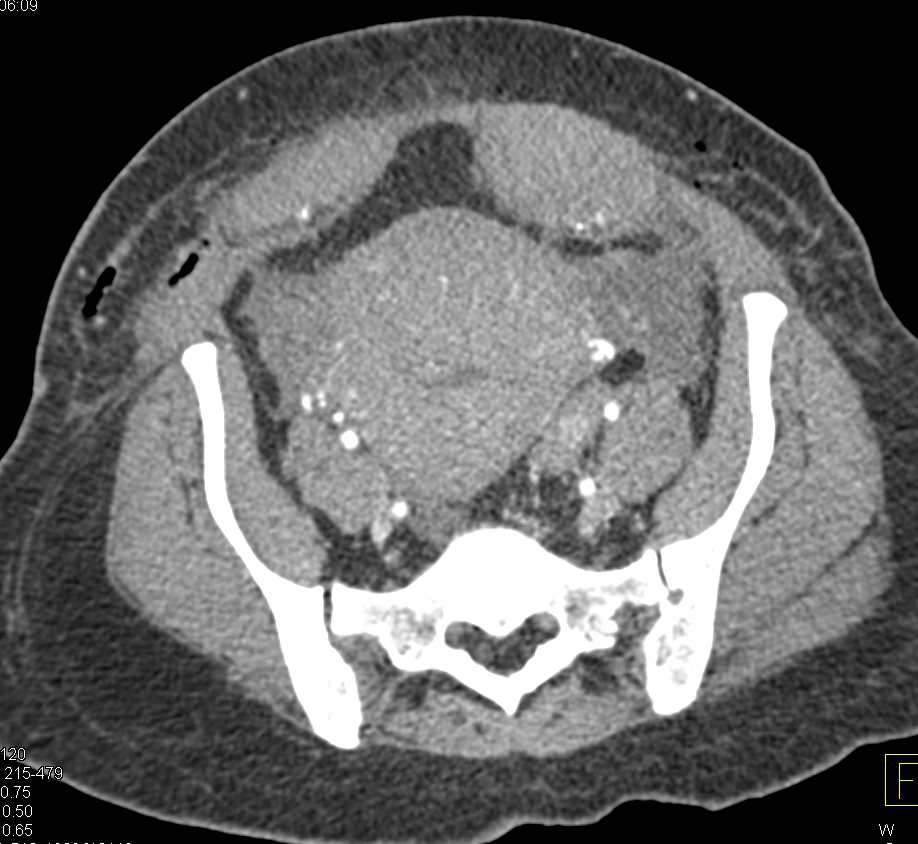 Postpartum Complications Including Pancreatitis and Small Bowel Obstruction (SBO) - CTisus CT Scan