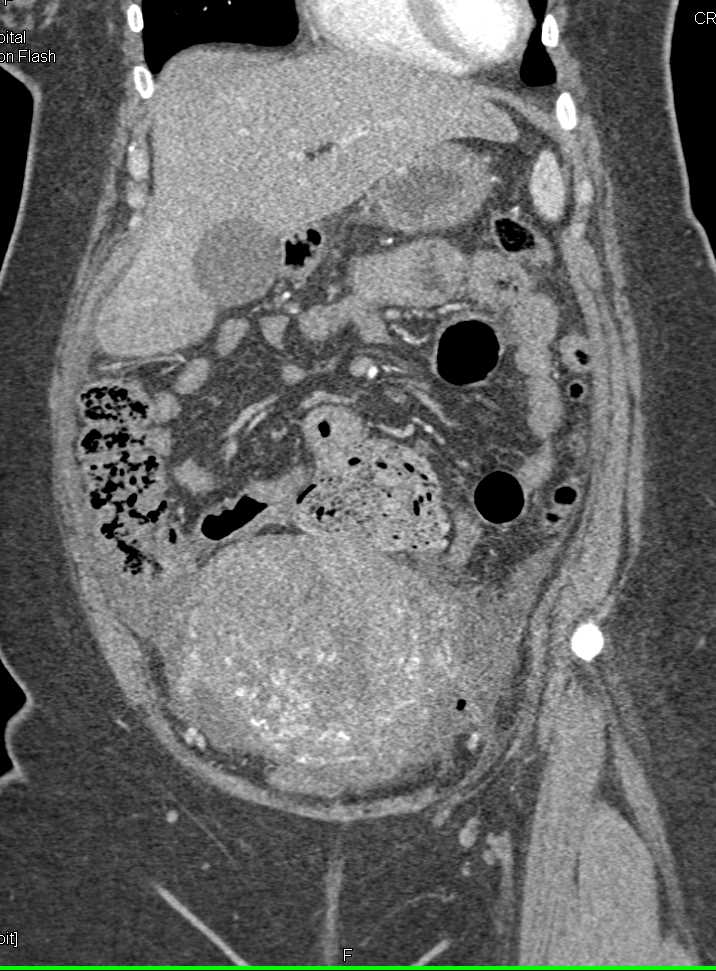 Retained Sponge in Patient S/P C-Section - CTisus CT Scan