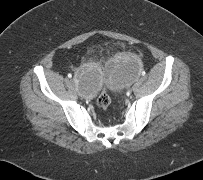 Bilateral Tubo-Ovarian Abscess - CTisus CT Scan