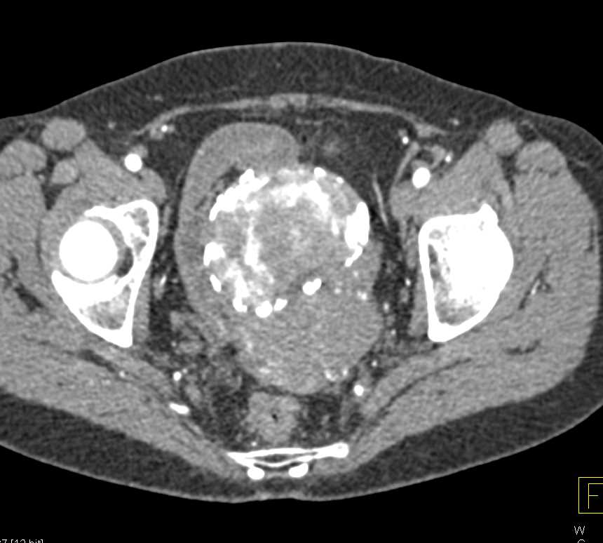 Calcified Uterine Fibroids - CTisus CT Scan