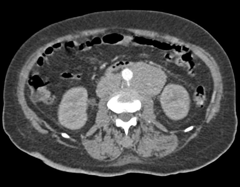 Uterine Sarcoma with Bulky Para-aortic Adenopathy - CTisus CT Scan
