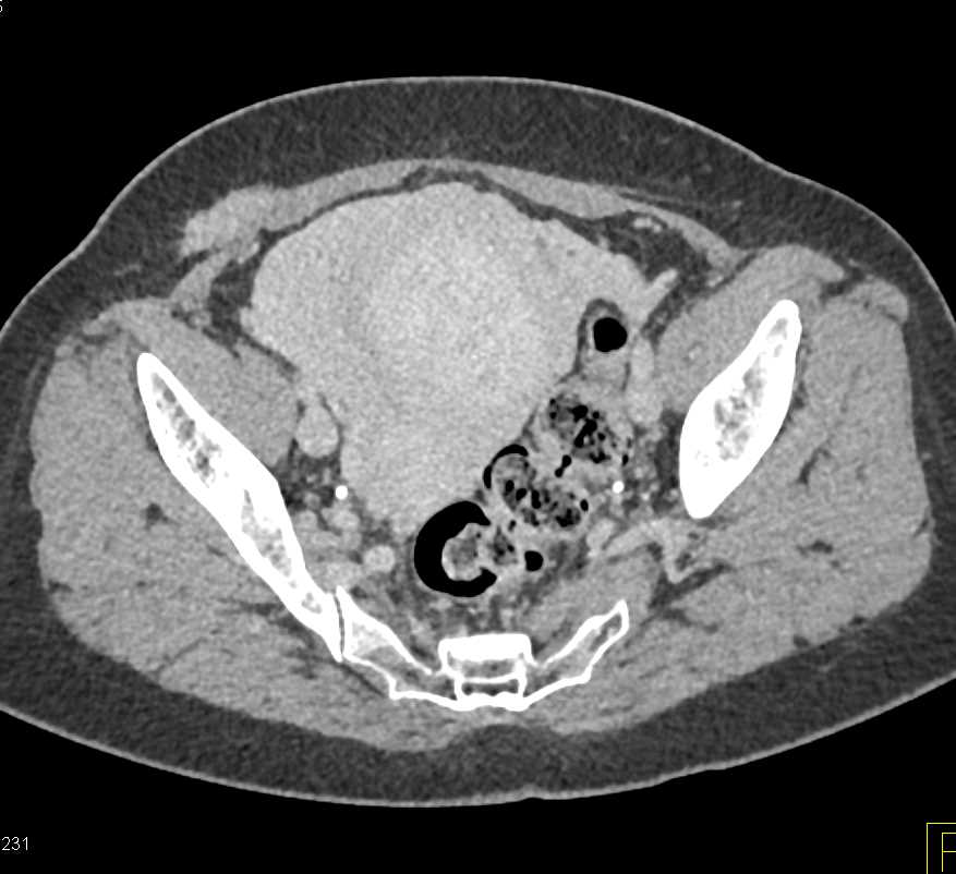 Uterine Fibroids - CTisus CT Scan