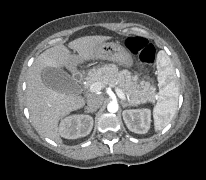 Post C-Section Changes Including Right Hydronephrosis - CTisus CT Scan