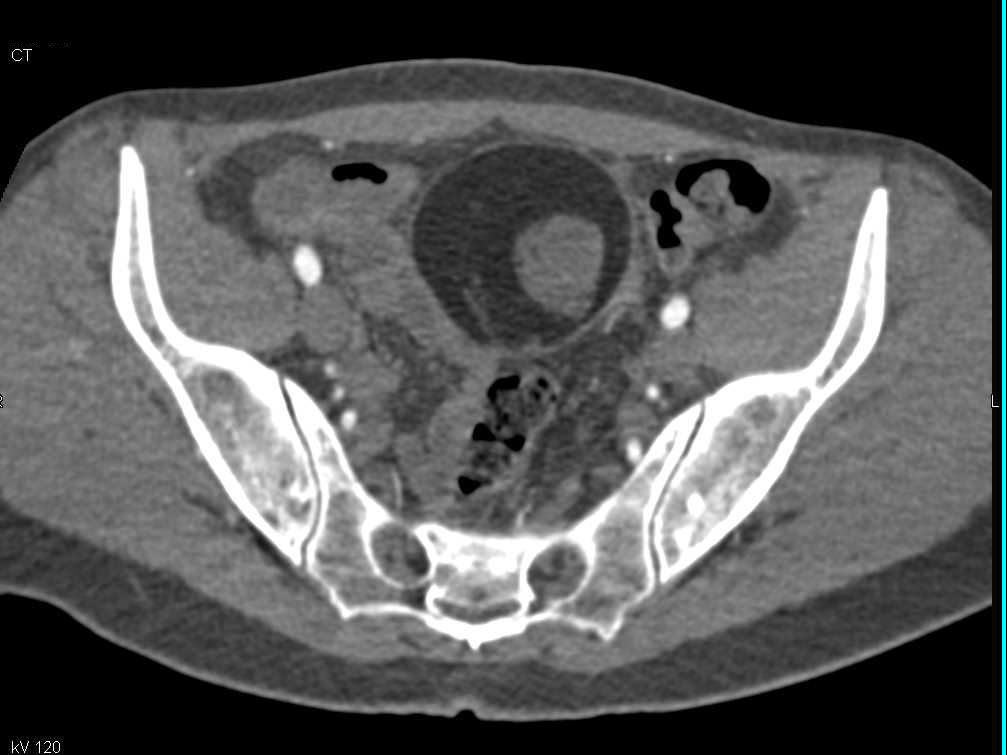 Ovarian Dermoid - CTisus CT Scan