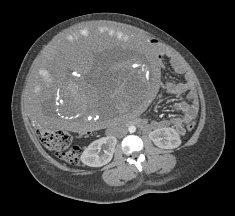 In Utero Pregnancy with Twins - CTisus CT Scan